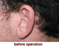 plastic-surgery-prominent-ear 